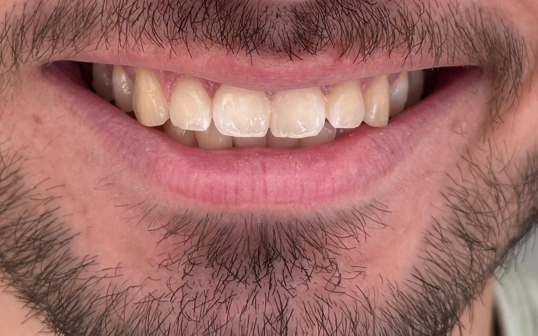 Antes: sorriso com os dentes amarelados