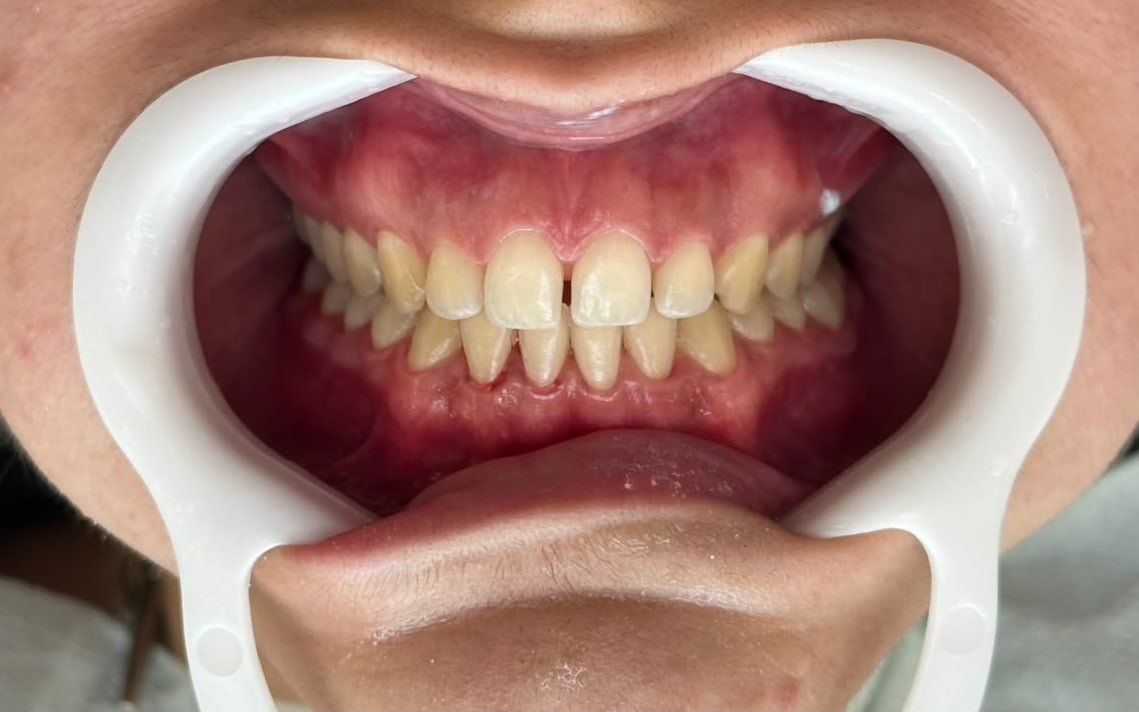 Antes: dentes amarelados, vistos de perto com afastador